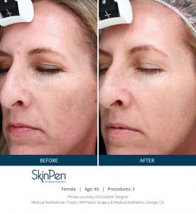 Skin Pen Before After Image 1