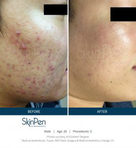 Skin Pen Before After Image 2