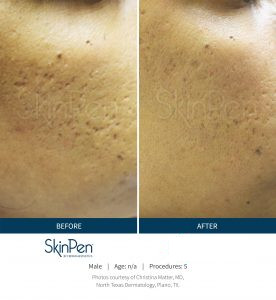 Skin Pen Before After Image 3