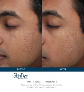 Skin Pen Before After Image 4