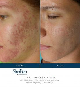 Skin Pen Before After Image 5