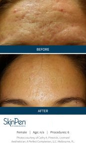 Skin Pen Before After Image 6