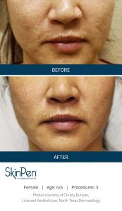 Skin Pen Before After Image 7