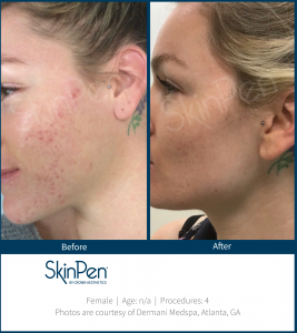 Skin Pen Before After Image 8