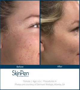 Skin Pen Before After Image 9